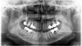 Panoramic dental Xray Royalty Free Stock Photo