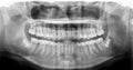 Panoramic dental Xray shows fixed teeth amalgam seal.X-ray for dental problems in toothache patient or trauma Royalty Free Stock Photo