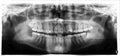 Panoramic image of the jaw, the location of the atypical / pathological wisdom tooth third molar. Medical research,