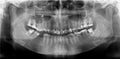 Panoramic radiograph is a panoramic scanning dental X-ray of the maxilla and mandible