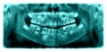 Panoramic radiograph is a scanning dental X-ray jaws of child