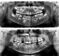 Panoramic radiograph is a scanning dental X-ray jaws