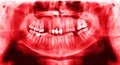 Panoramic radiograph is a scanning dental X-ray jaws of young man Royalty Free Stock Photo