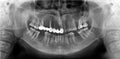 Panoramic radiograph is a panoramic scanning dental X-ray of the maxilla and mandible Royalty Free Stock Photo