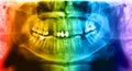 Panoramic radiograph is a scanning dental X-ray jaws of young man Royalty Free Stock Photo