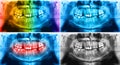 Panoramic radiograph is a scanning dental X-ray jaws of young man Royalty Free Stock Photo