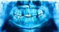 Panoramic radiograph is a scanning dental X-ray jaws of young man Royalty Free Stock Photo