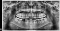 Panoramic scanning dental X-ray of the upper and lower jaw Orthopantomogram or OPG