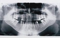 Panoramic x-ray skan Royalty Free Stock Photo