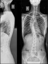 Single arc right sided deformity of the thoracic spine