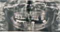 Panoramic X-ray of teeth. Dental treatment in dentistry. Female sick teeth.