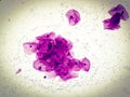 Pap\'s smear microscopic showing severe inflammatory epithelial cells.