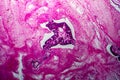 Papillary serous ovarian adenocarcinoma, light micrograph