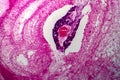 Papillary serous ovarian adenocarcinoma, light micrograph