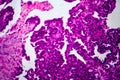 Papillary serous ovarian adenocarcinoma, light micrograph