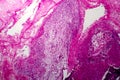 Papillary serous ovarian adenocarcinoma, light micrograph