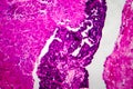 Papillary serous ovarian adenocarcinoma, light micrograph