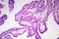 Papillary thyroid cancer, light micrograph Royalty Free Stock Photo