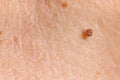 Papilloma on human skin - benign tumor in the form of mole, nevus Papillomatosis medicine