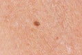 Papilloma on human skin - benign tumor in the form of mole, nevus Papillomatosis medicine Royalty Free Stock Photo