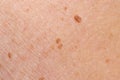 Papilloma on human skin - benign tumor in the form of mole, nevus Papillomatosis medicine Royalty Free Stock Photo