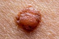 Papilloma mole on human skin macro shot, concept of health, skin care and cancer risk