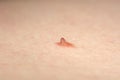 Papilloma nevus or mole on human skin Royalty Free Stock Photo