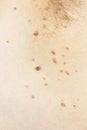 Papilloma virus in the armpit of a man, a dermatological problem, the concept of skin disease.