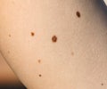 Papillomas on human skin as a background.