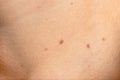 Papillomas or mole on female neck close up background