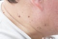Papillomas on a person`s neck.Human skin disease
