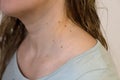 Papillomas on the woman neck close up