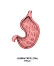 Papillomatosis of the stomach