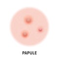 Papule skin acne type vector icon. Skin disease acne papule pimples type, face pore comedones