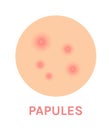 Papules. Acne Icon. Problem Skin. Zoom. Close up of Pimples. Inflammation and Rash. Red Pink Infection. Flat Color Cartoon style.