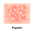 Papules on the skin. Acne. Pimples on the skin. Infographics. Vector illustration.