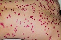 Papules on the skin of a patient with chickenpox close-up.