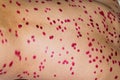 Papules on the skin of a patient with chickenpox close-up