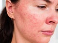 Papulopustular rosacea, the patient`s cheek - the consequences of prolonged wearing of a mask