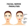 Paralysis of the facial nerve. Bell`s palsy