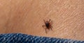 The parasite mite sits on a persons skin. infection carrier. Ixodes ricinus Royalty Free Stock Photo