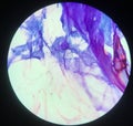 Parasite Strongyloides stercoralis in sputum smear