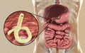 Parasitic hookworm Ancylosoma duodenale in human duodenum