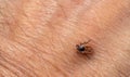 A parasitic tick crawls along on human skin.