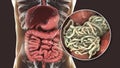 Parasitic worms in human intestine