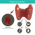 Parathyroid Adenoma. Illustration.