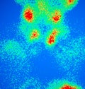 Parathyroid adenoma nuclear scan