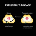 Parkinson`s disease. Degenerative changes in the brain are a black substance. Vector illustration on black background.