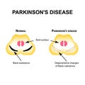 Parkinson`s disease. Degenerative changes in the brain are a black substance. Vector illustration on isolated background.
