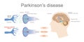 Parkinson`s Affected neuron. Health care education infographic. Royalty Free Stock Photo